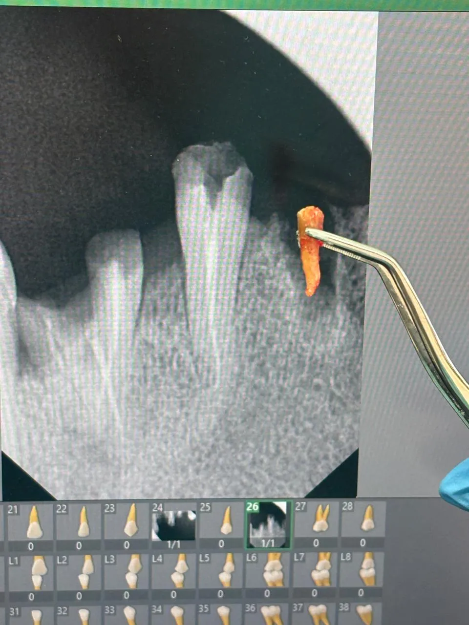 Contrôle radiographique et suivi clinique